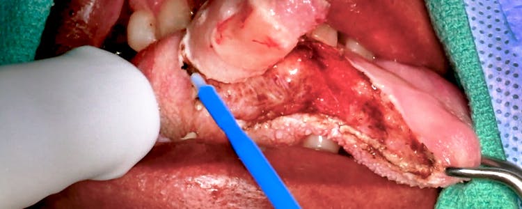 partial-glossectomy