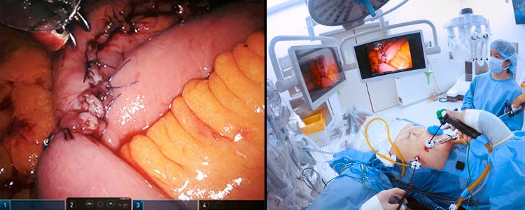 robotic-assisted-proximal-gastrectomy-with-a-laparoscopic-assisted-double-tract-reconstruction-for-proximal-early-gastric-cancer