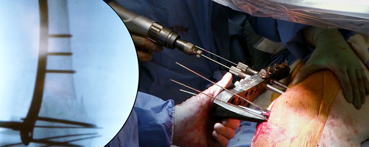 Less Invasive Stabilization System (LISS) for Distal Femur Fracture Repair