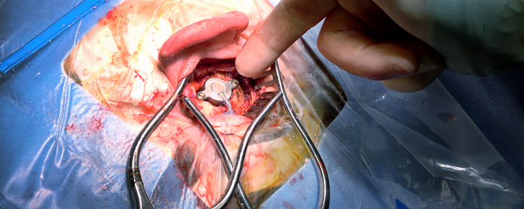 Bonebridge Implant