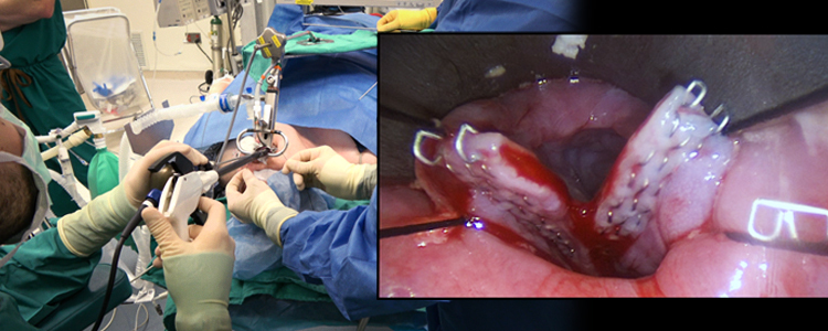 Zenker’s Diverticulum: Endoscopic Staple-Assisted Diverticulotomy