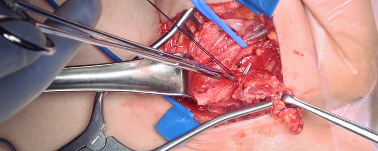 left-lateral-neck-dissection-for-metastatic-papillary-thyroid-carcinoma