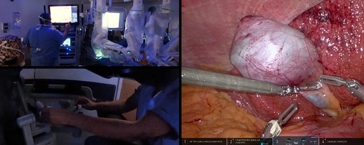 Robotic-Assisted Cholecystectomy for Porcelain Gallbladder and Cholelithiasis