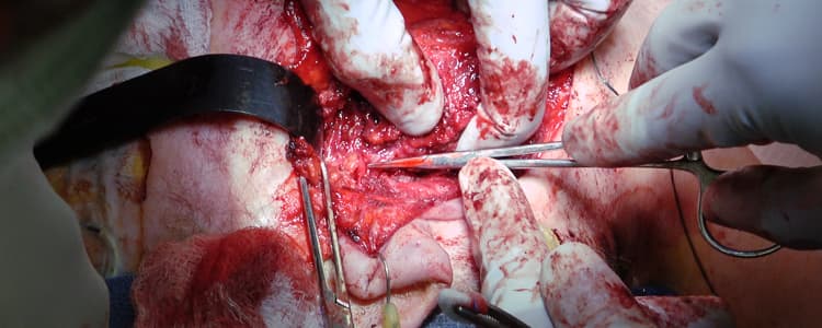 subtotal-parotidectomy-and-unilateral-lateral-neck-dissection-levels-ii-iii-and-iv-for-right-parotid-mucoepidermoid-carcinoma-involving-the-deep-and-superficial-lobes-and-extending-into-parapharyngeal-space