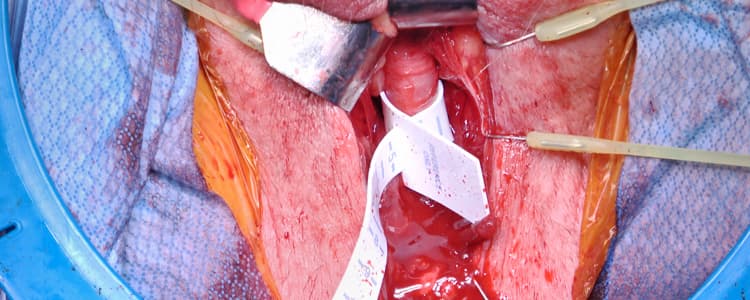 Artificial Urinary Sphincter Placement for Male with Urinary Incontinence Following Radical Prostatectomy