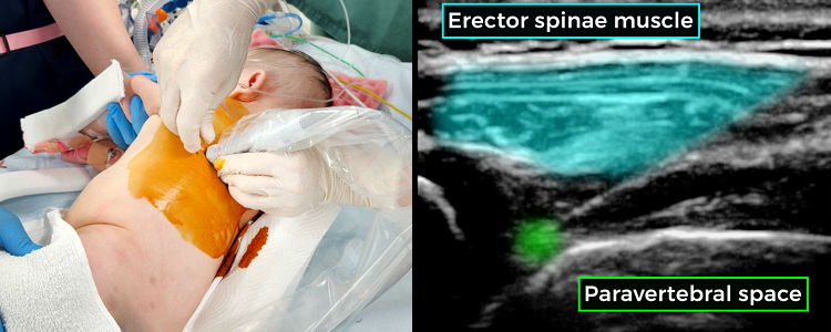 Ultrasound-Guided Paravertebral Block in an Infant