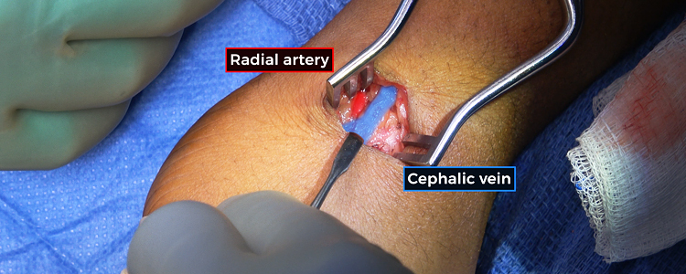 Snuffbox Radiocephalic Arteriovenous Fistula Creation for End-Stage Kidney Disease
