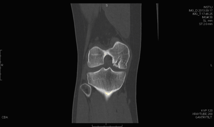 Coronal computed tomography imaging demonstrating bony aspect of the defect