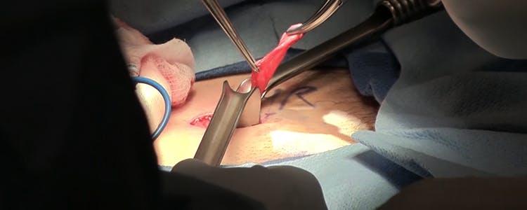 minimally-invasive-open-inguinal-hernia-repair