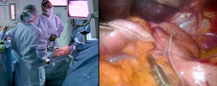 laparoscopic-resection-of-gastric-gist-tumor