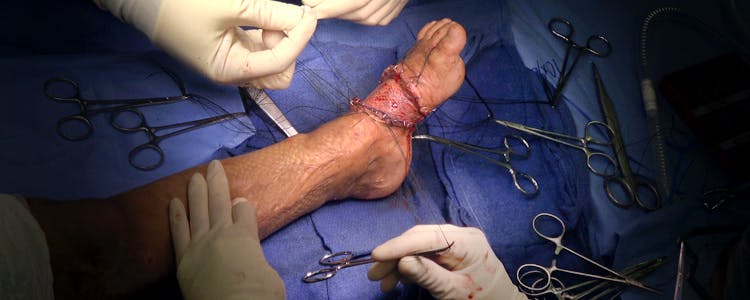 Bilateral-Dorsal-Foot-Scar-Contracture-Release-with-Split-Thickness-Skin-Grafts-from-the-Anterior-Thigh