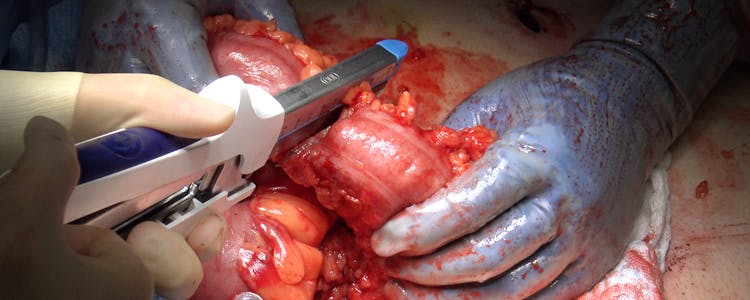 laparoscopic-low-anterior-resection-with-diverting-loop-ileostomy-for-rectal-cancer-with-conversion-to-open-approach