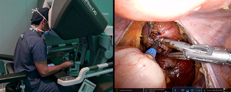 robotic-low-anterior-resection-with-diverting-loop-ileostomy-for-locally-advanced-rectal-cancer