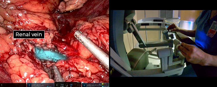 robotic-assisted-laparoscopic-left-donor-nephrectomy-for-living-kidney-donation