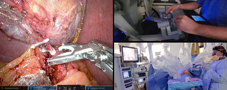 robotic-cholecystectomy-for-recurrent-gallstone-pancreatitis-in-a-patient-with-prior-distal-pancreatectomy-and-splenectomy-for-acinar-cell-carcinoma