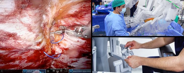 robotic-preperitoneal-etep-repair-for-umbilical-hernia-and-diastasis