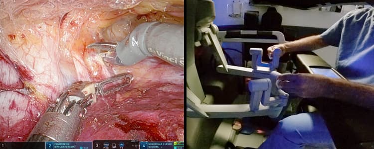 robotic-transversus-abdominis-release-tar