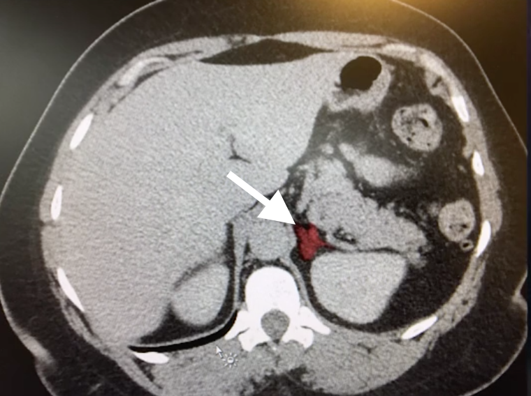 Figure 1.Abdominal CT
Non-contrast CT image revealing a lesion (white arrow) in the area of the left adrenal gland.