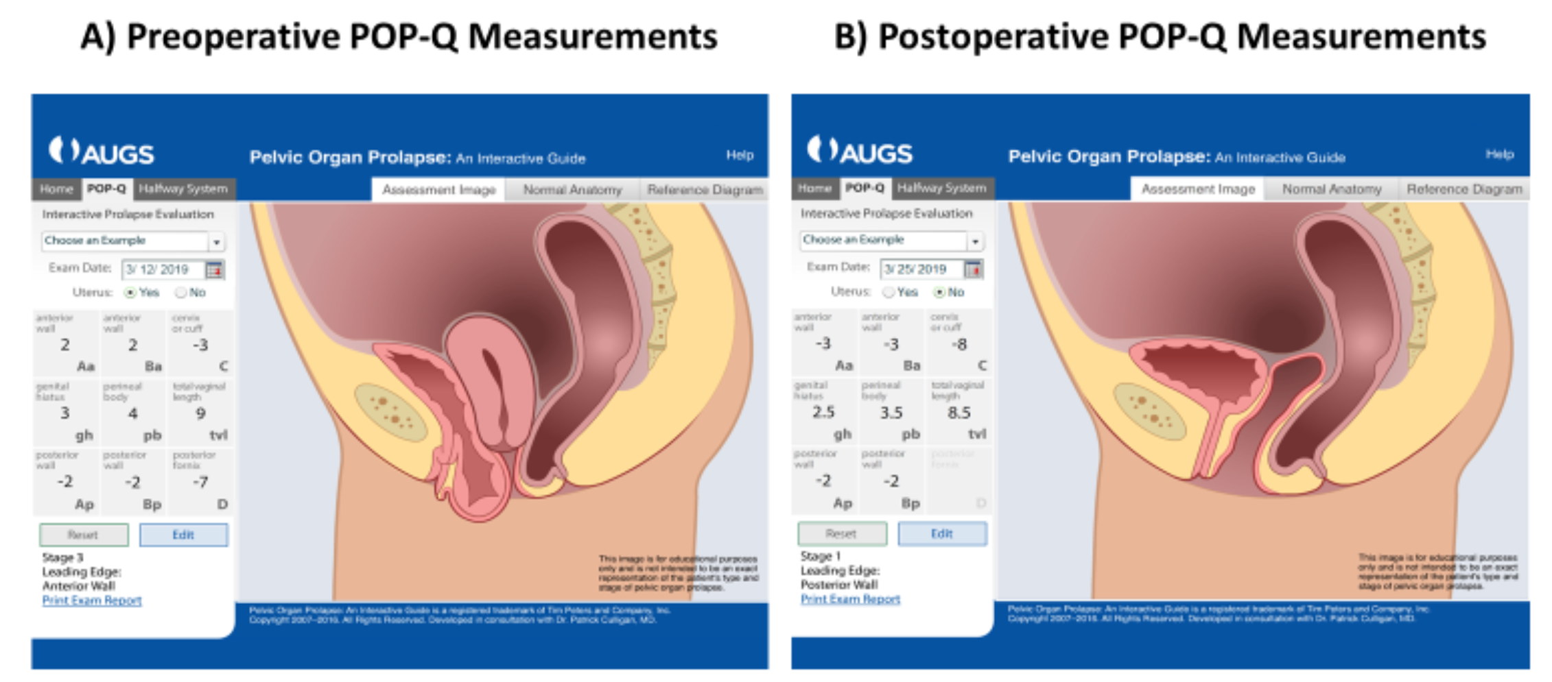 Figure 1. Graphic Demonstration of Pre- and Postoperative POP-Q Measurements