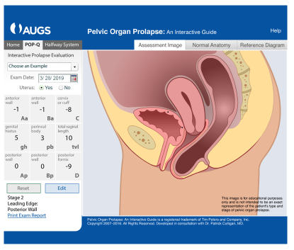 Graphic Demonstration of Preoperative POP-Q Measurements. Used with permission from the American Urogynecologic Society (AUGS).